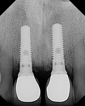 Implant Radiograph