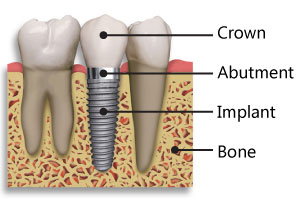 Implant Diagram - Crown, Abutment,
					  Implant, Bone